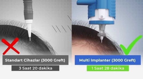 Technique de greffe de cheveux multi-implanteurs
