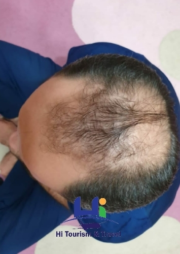 Sapphire Fue Hair Transplant Technique