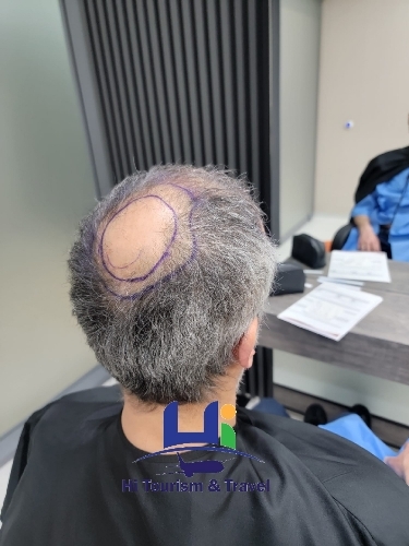 Sapphire Fue Hair Transplant Technique